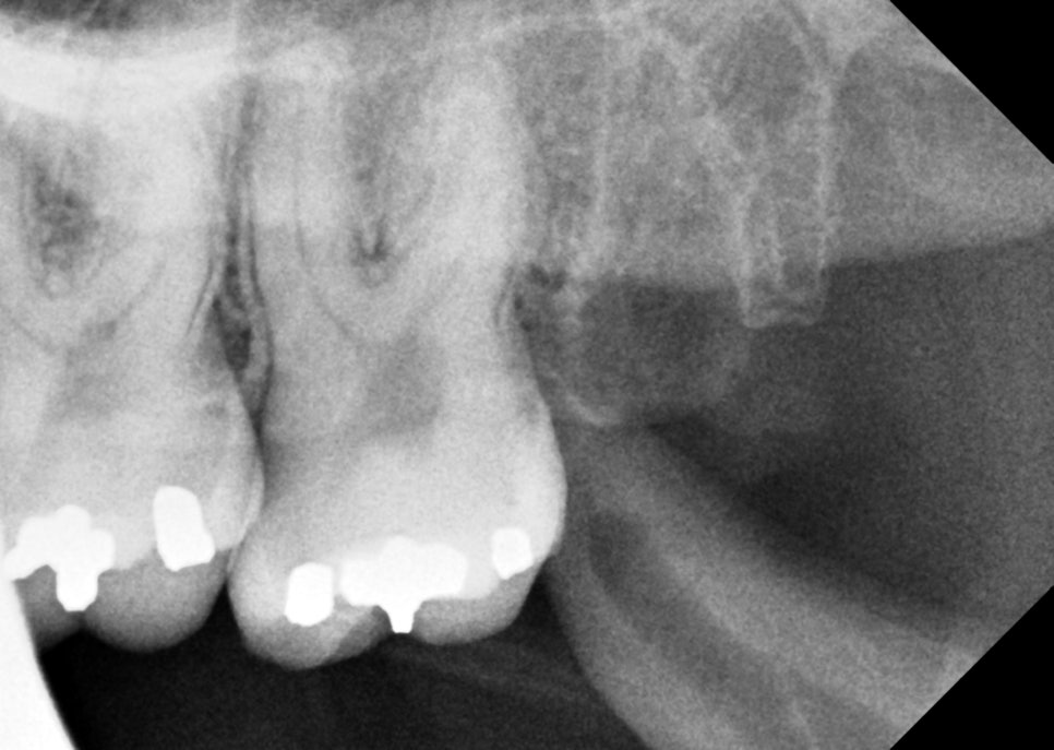 사랑니발치 매복 돼도 이렇게 빼면 안전해요 관련 이미지 9