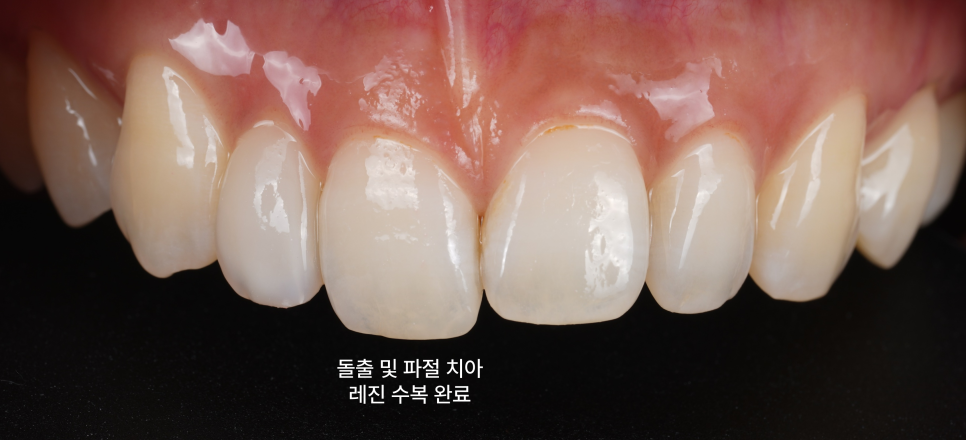 왜소치 레진으로 삭제 없이 예쁘게 관련 이미지 13