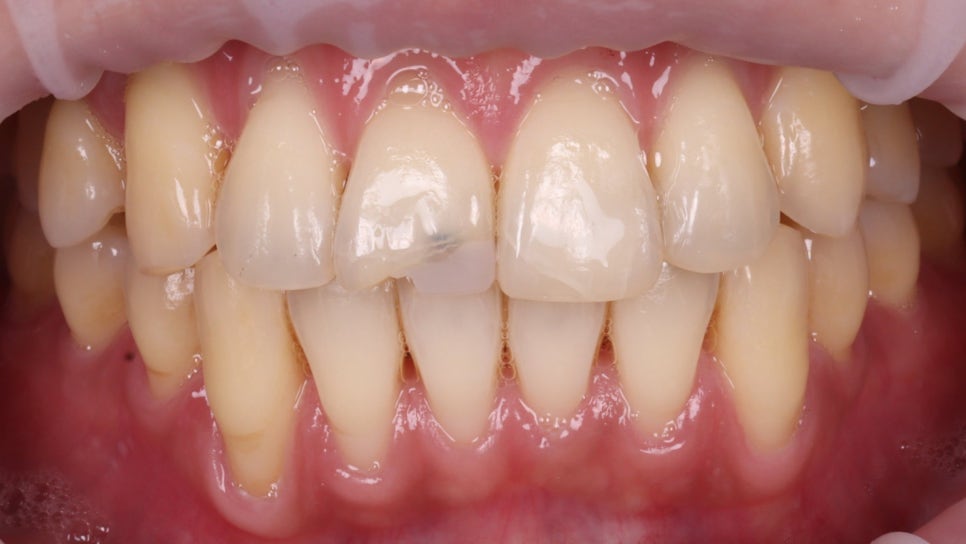 강남역치과 앞니 파절 크라운 말고 레진으로 하세요 관련 이미지 4