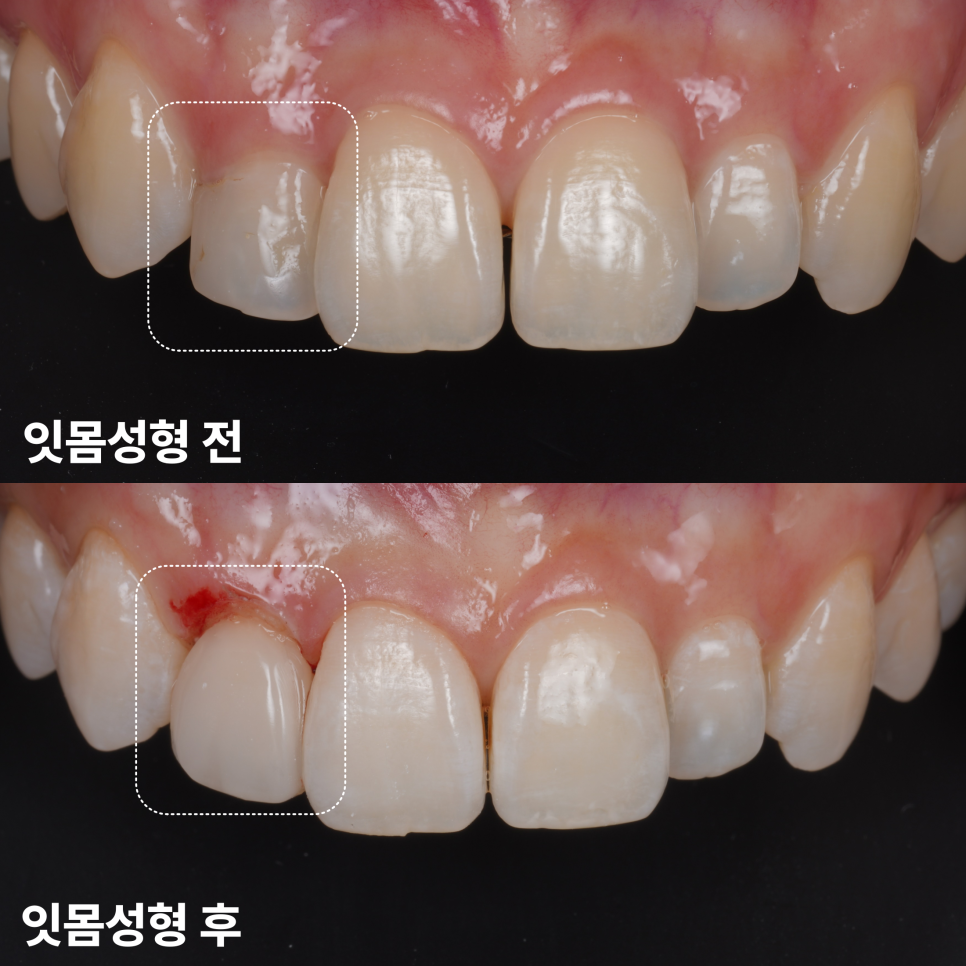 왜소치레진 20년 전에 했던 치아 재치료 후 반대쪽까지 관련 이미지 13