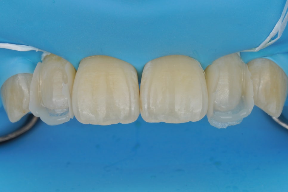 왜소치 레진, 갤럭시네이트 레진비니어로 당일 치료완료 (서초동 치과) 관련 이미지 8