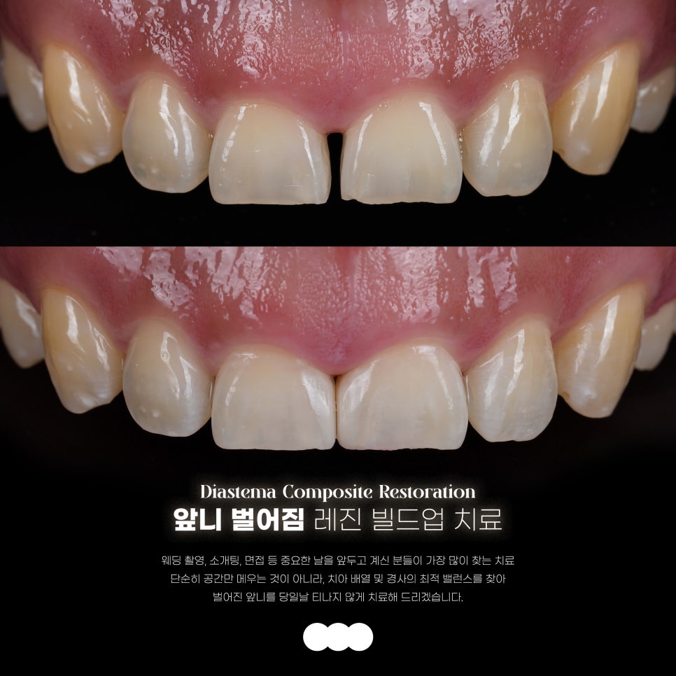 앞니 벌어짐 레진으로 삭제없이 충분히 예쁘게 할 수 있어요 관련 이미지 11