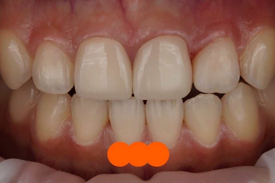 서초동 앞니 사이 충치, 기존 레진 제거 후 다시 치료 했습니다. 관련 이미지 5