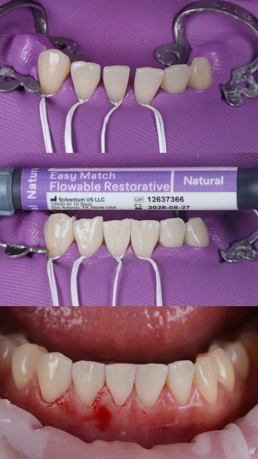 Multiple Gaps Between the Lower Front Teeth Below Gyodae Station—Filled in a Single Day image 3