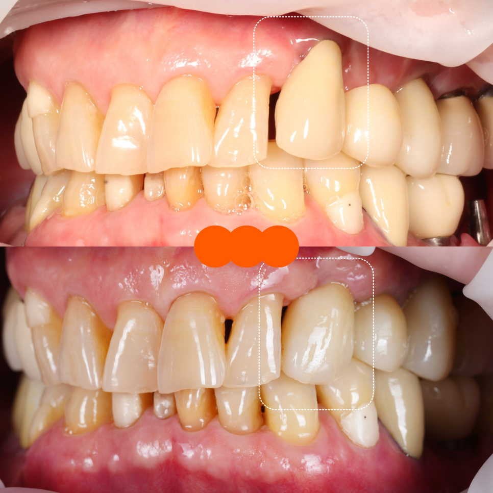 선릉역치과 타원 앞니 임플란트 빼고 재수술 해드린 이유 관련 이미지 11