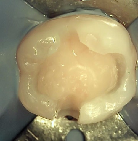 인레이치료 하방 2차 충치 레진 빌드업 사례 관련 이미지 13