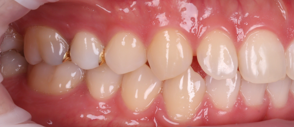 Apgujeong Dental Clinic: 3 Things Needed for Successful Resin Treatment of Peg Laterals image 4