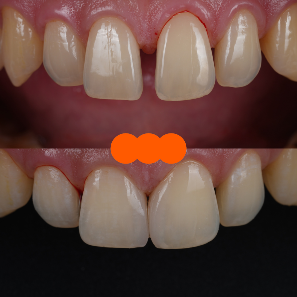 서울치과 앞니 레진 전 이걸 먼저 확인해야 돼요 관련 이미지 10