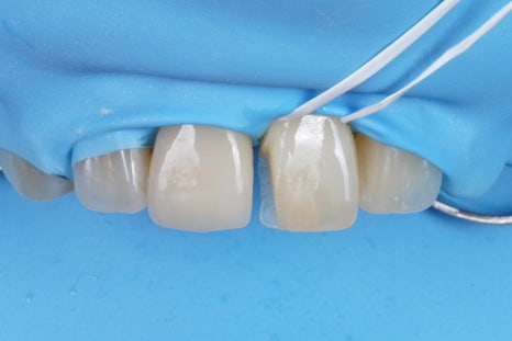 앞니 깨짐 레진 어디서할지 고민될 때 꼭 보세요 관련 이미지 6