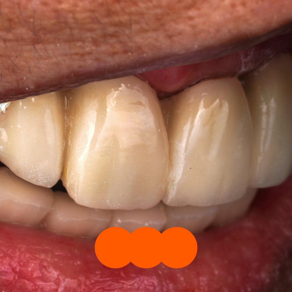 앞니 임플란트 PFM 보철 도자기 깨짐, 당일 수리해주는 서초 치과 관련 이미지 2