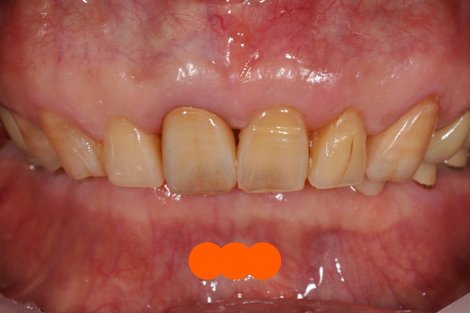 60년 전 신문배달할 때 다쳐서 씌운 앞니 크라운 변색, 지르코니아 재치료 관련 이미지 7