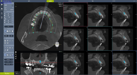 왜 재주좋은치과 호랑플란트&trade;로 치료해야 하나요? 서초동 임플란트 고민 해결 관련 이미지 2
