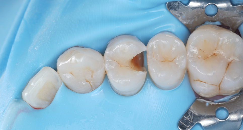 강남역치과 치료 부위 2차 충치 레진 재치료 사례 관련 이미지 9