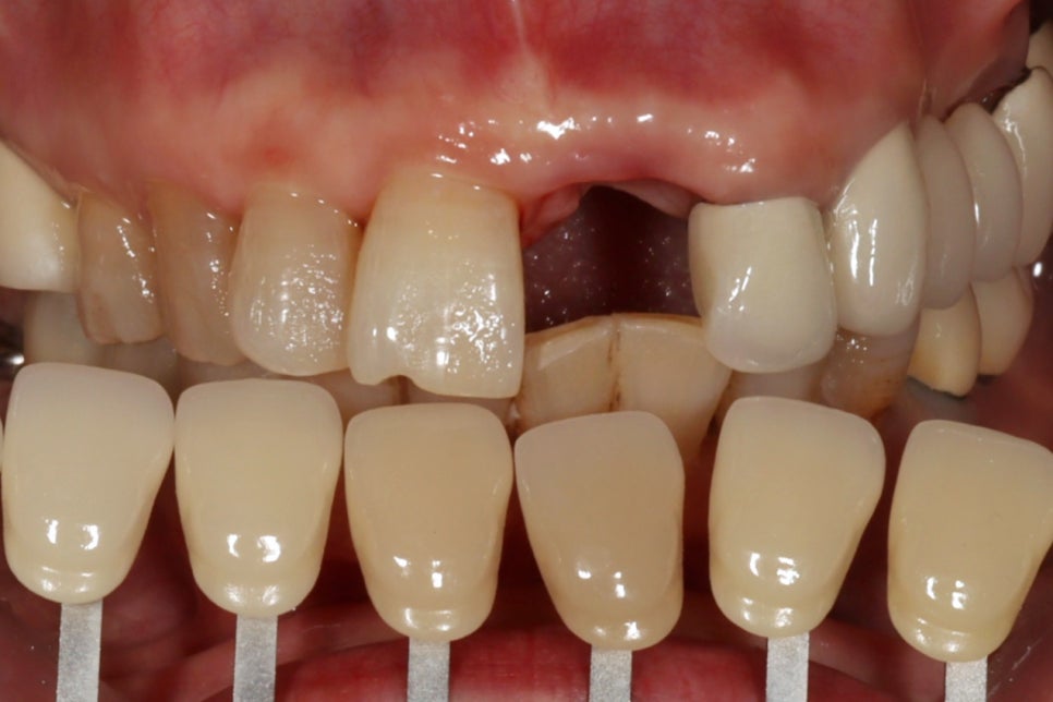 교대역 앞니 임플란트 후기, 자연스러운 지르코니아 크라운 관련 이미지 3