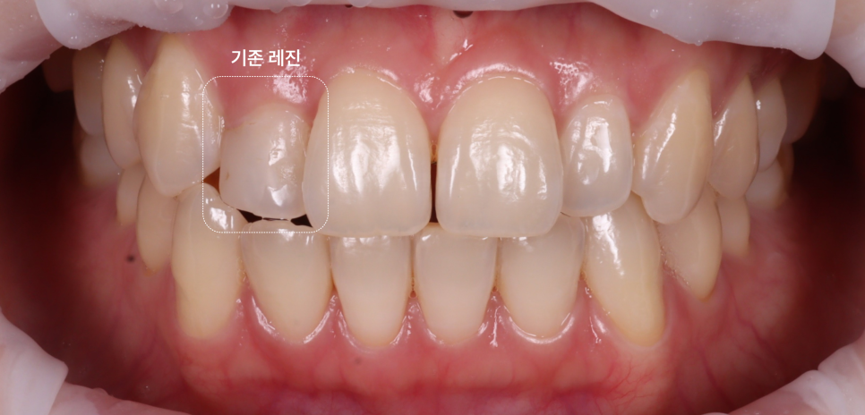 왜소치레진 20년 전에 했던 치아 재치료 후 반대쪽까지 관련 이미지 1