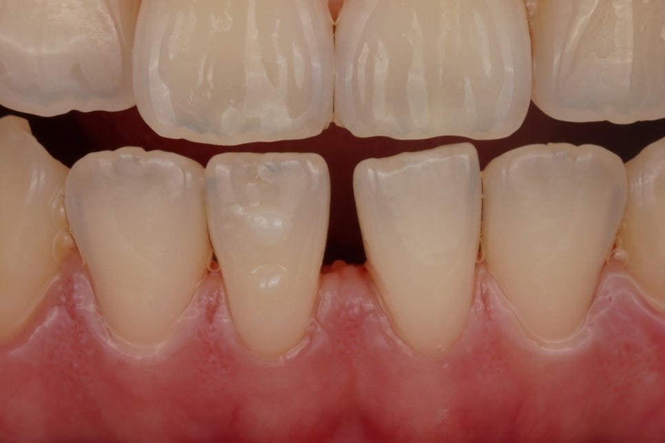 앞니 벌어짐 레진 당일 치료, 앞니 레진 잘하는 서초동 치과 관련 이미지 5