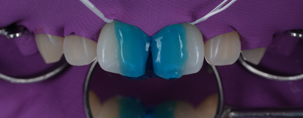 방배동치과 앞니 벌어짐 해결하러 강릉에서 오셨어요 관련 이미지 9