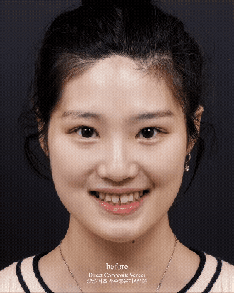 앞니 벌어짐 레진 비니어 후 미인대회 출전 관련 이미지 13