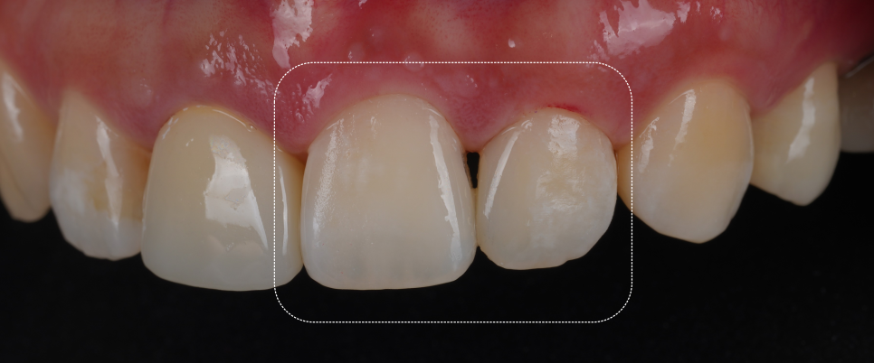 서초동치과 전라도 광주에서 레진 재치료 받으러 오신 사례 관련 이미지 11