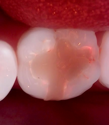 치과보존과 치아를 덜 깎는 치료를 지향하는 이유 관련 이미지 9