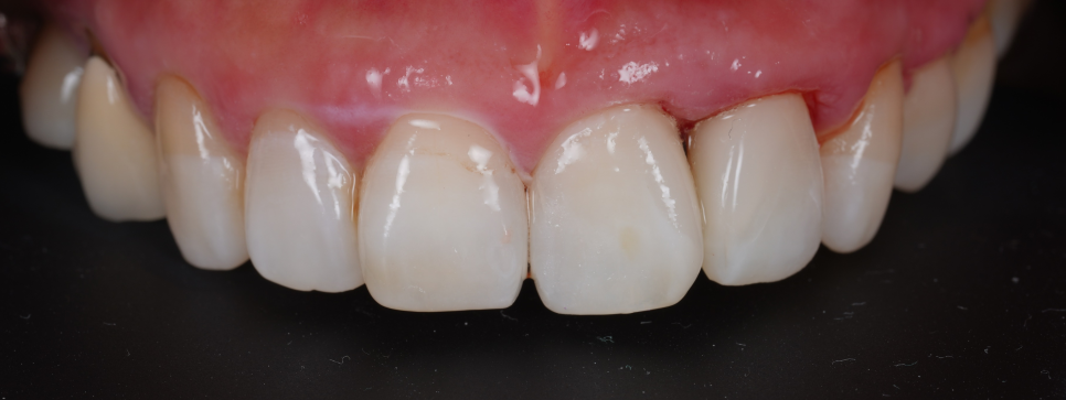 잘못된 앞니 레진 뼈까지 녹인다? 레진 재치료 과정 관련 이미지 15