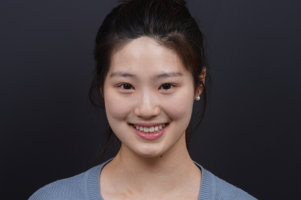 앞니 벌어짐 레진 비니어 후 미인대회 출전 관련 이미지 12