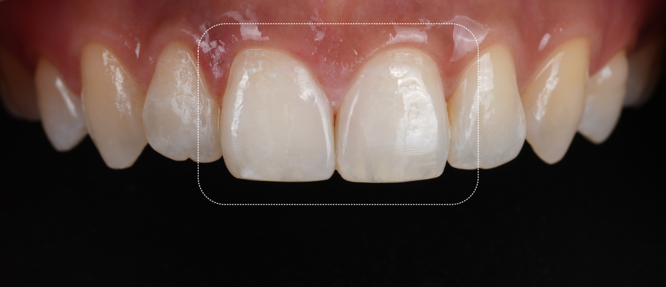 앞니사이충치 레진으로 치아성형 효과까지 낼 수 있어요 관련 이미지 8