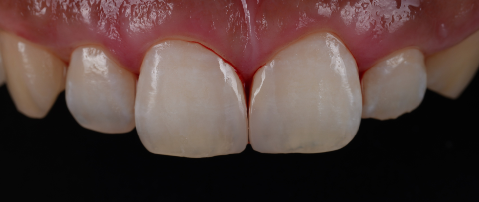 양재역치과 앞니 레진 받으러 수원에서 오신 이유(feat. 치과의사 소개) 관련 이미지 10