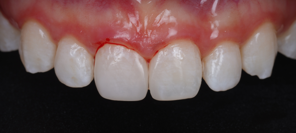 앞니 벌어짐 레진 비니어 후 미인대회 출전 관련 이미지 11
