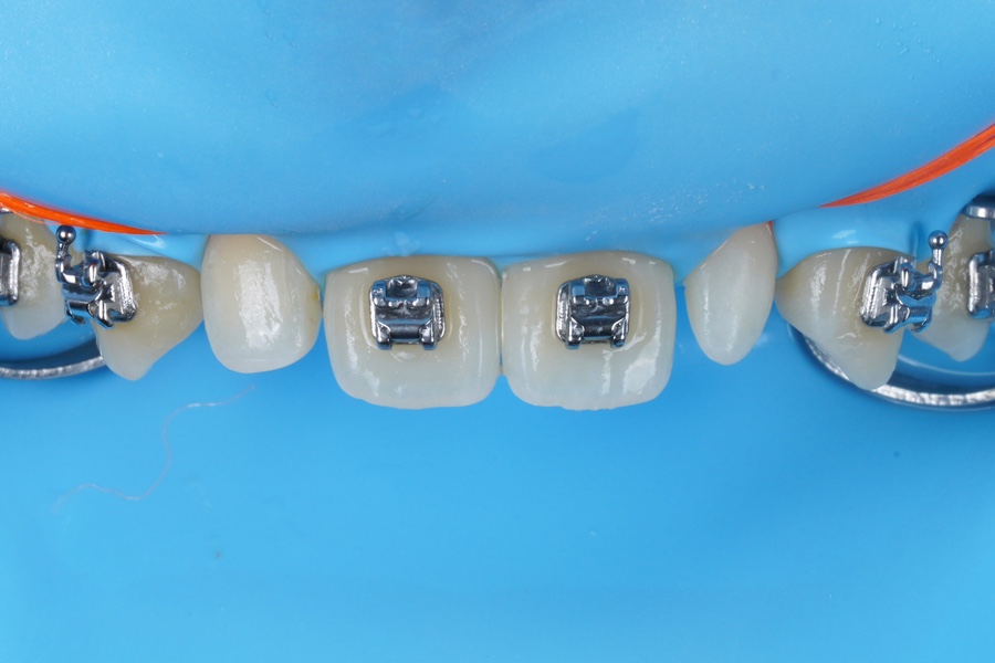 왜소치 레진 비니어, 교정 마무리 할 때 오시면 참 좋습니다. 관련 이미지 4