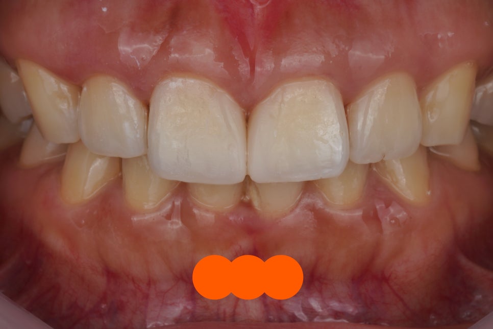 앞니 벌어짐을 레진 비니어로 당일 치료한 서초동 치과 관련 이미지 4