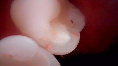 교대역 치과 보철 아래 2차 충치를 다시 레진으로 관련 이미지 8