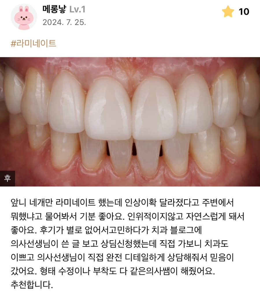앞니 벌어짐 레진으로 삭제없이 충분히 예쁘게 할 수 있어요 관련 이미지 3