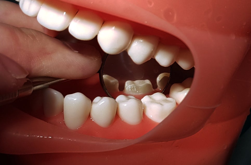 치과 공보의 일기 (62) : 10분 프렙 관련 이미지 2