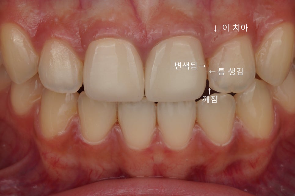 서초동 앞니 사이 충치, 기존 레진 제거 후 다시 치료 했습니다. 관련 이미지 1