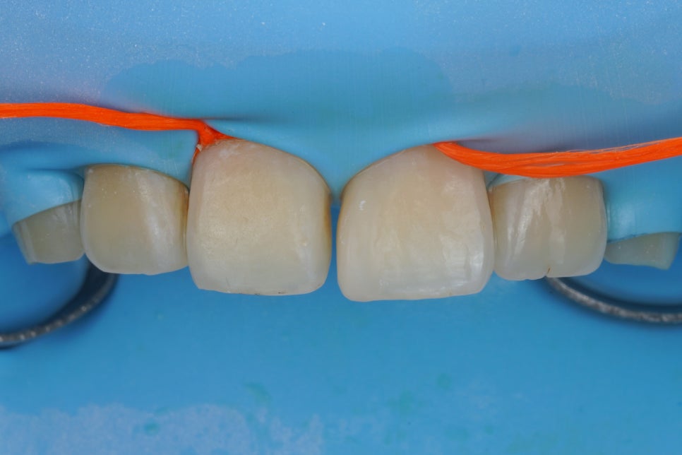 앞니 벌어짐을 레진 비니어로 당일 치료한 서초동 치과 관련 이미지 6