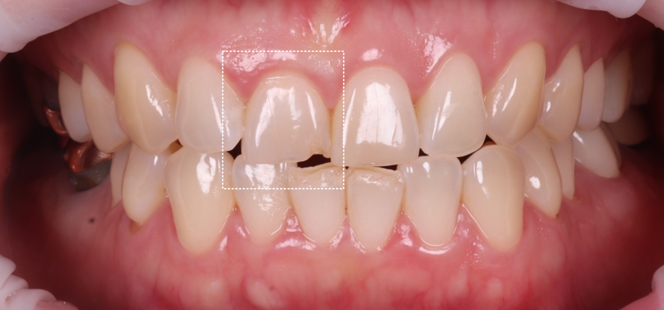Gangnam Dental Clinic: Resin Restoration Process for a Chipped Front Tooth Considering Tooth Position image 3