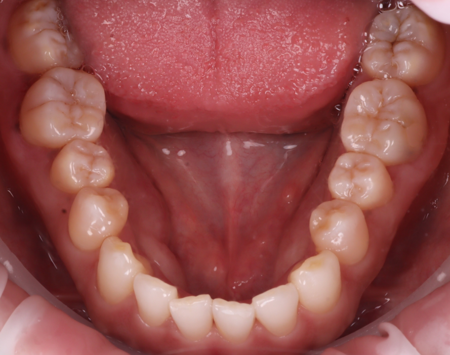 앞니 왜소치 레진 치과의사 소개로 내원해 당일 완료 관련 이미지 8