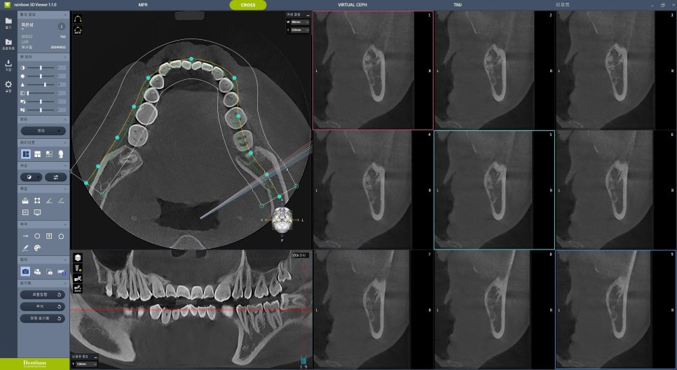 교대역 누운 매복 사랑니 당일 발치, 강남대성 별관에서 온 학생 관련 이미지 2
