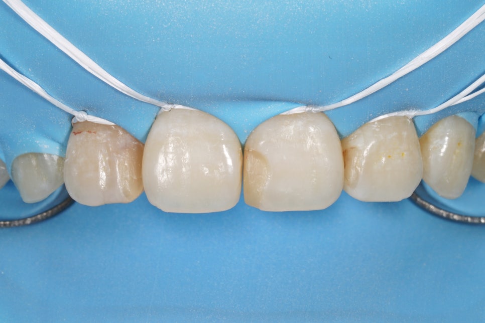 교대역, 교정 끝나고 앞니 사이 충치 레진 재치료 (유지장치 붙이기 전에 오세요) 관련 이미지 3