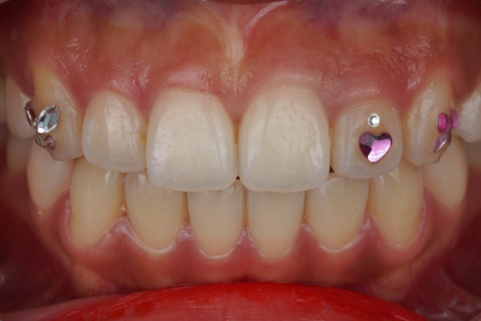 요즘 투스젬 맛집, 근데 이제 제거 맛집인- 투스젬 제거킹 재좋치 관련 이미지 1