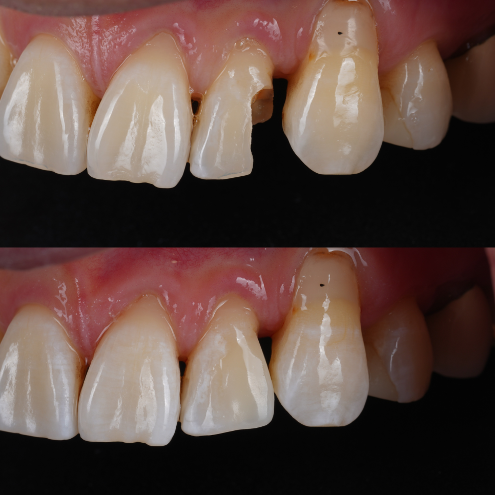 서초구치과 레진 탈락 재치료 2가지가 성공 핵심입니다 관련 이미지 11