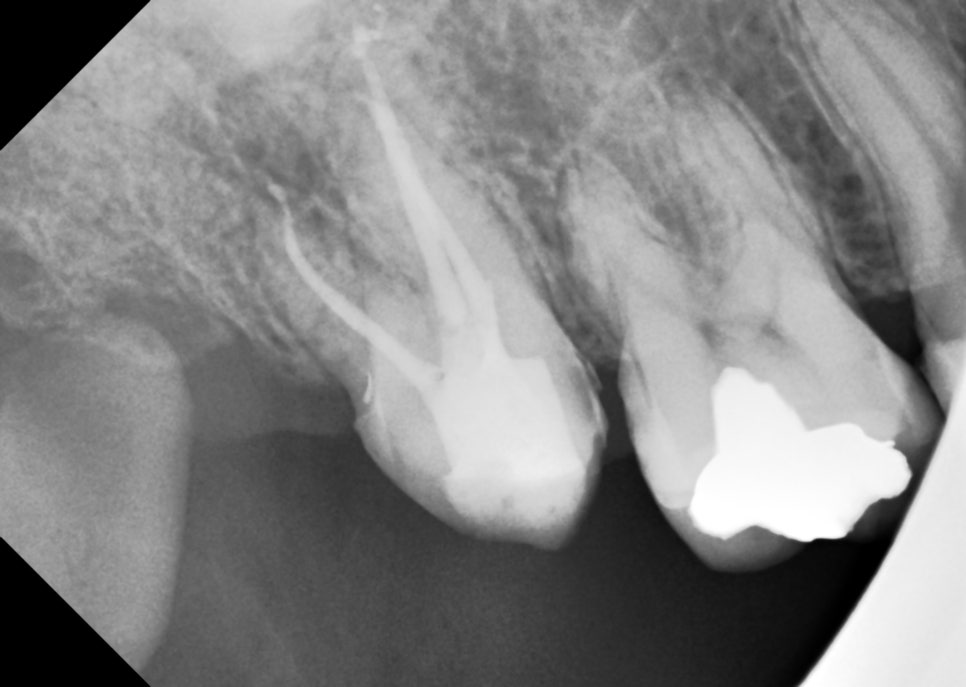 동기 치과의사의 부탁으로 어금니 신경치료만 마무리 해드린 케이스 관련 이미지 6