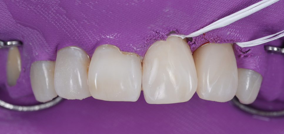 잘못된 앞니 레진 뼈까지 녹인다? 레진 재치료 과정 관련 이미지 14