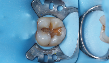 서초동치과 치아 삭제 원하지 않는다면 오버레이 하세요 관련 이미지 2