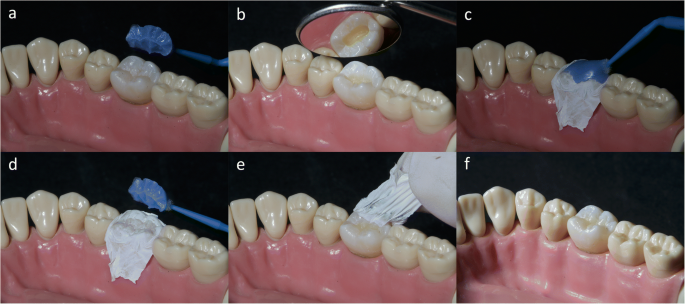 어금니 충치를 레진 스탬프 테크닉으로 치료해 보세요 관련 이미지 6