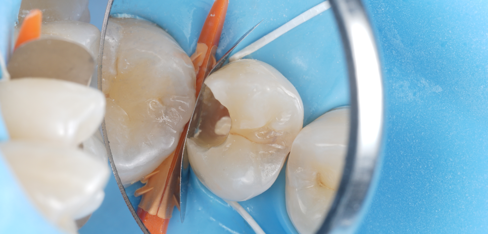 서초역치과 이걸로 신경치료 미뤄드리고 있어요 관련 이미지 11