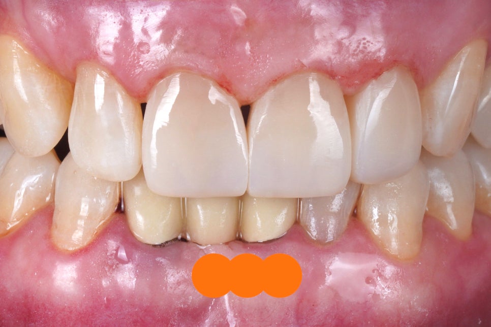 앞니 실금, 부모님 나이 든 치아 라미네이트 건강선물 관련 이미지 2