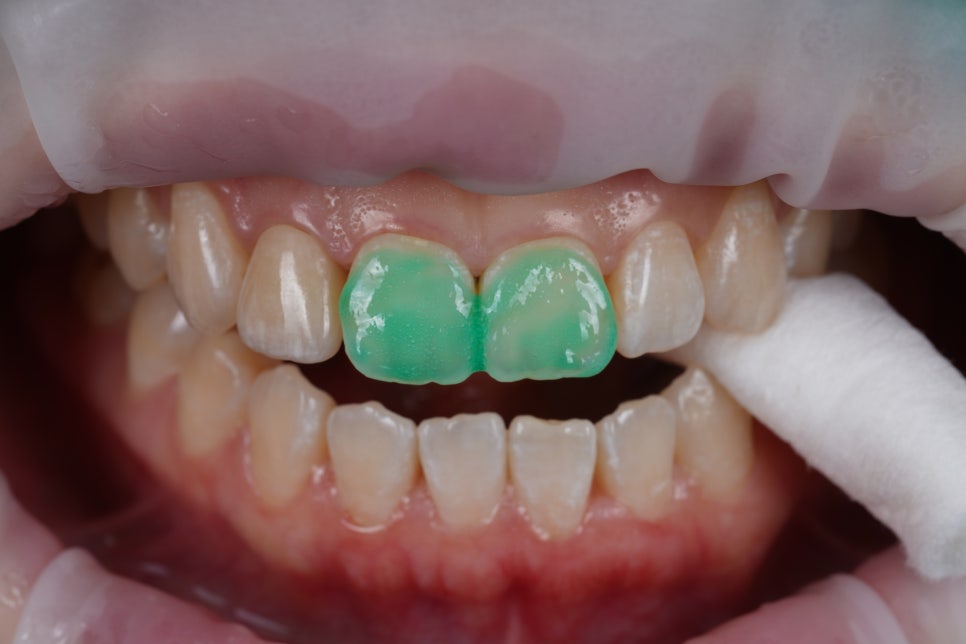 앞니 갈색 반점, 무삭제로 얼룩 제거 시술 : 아이콘 침투 관련 이미지 4