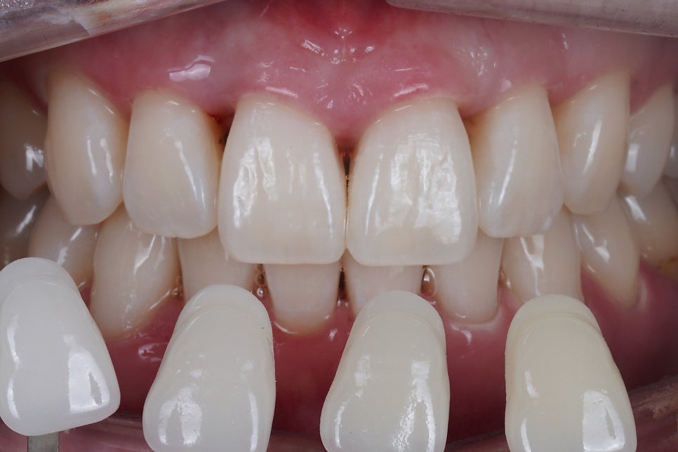 블랙 트라이앵글 (블트) 레진으로 건강하게 치료하는 방법 관련 이미지 1